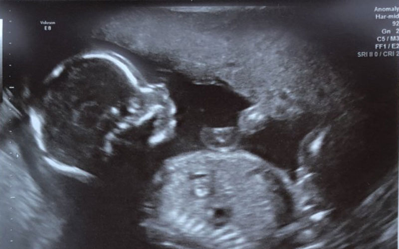 سونوگرافی هفته بیست و یکم بارداری