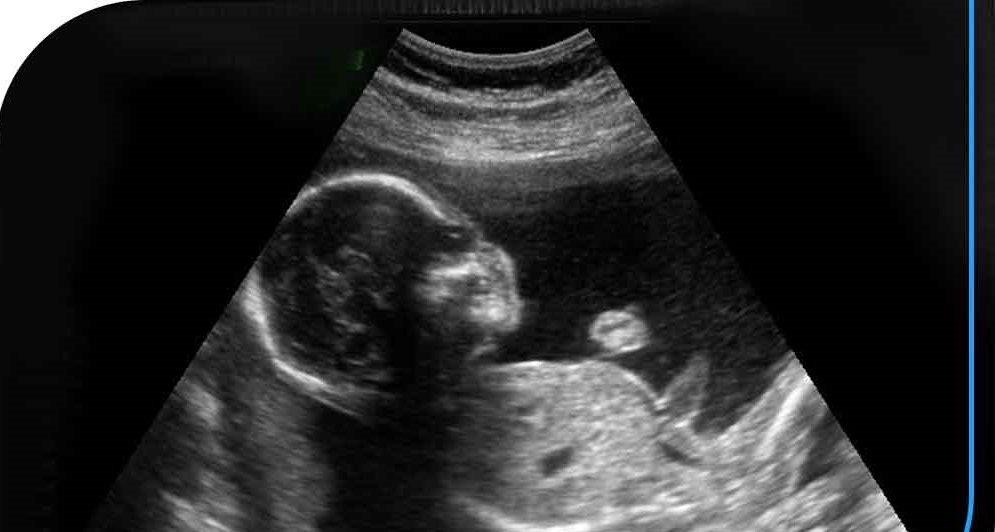سونوگرافی در هفته نوزدهم بارداری